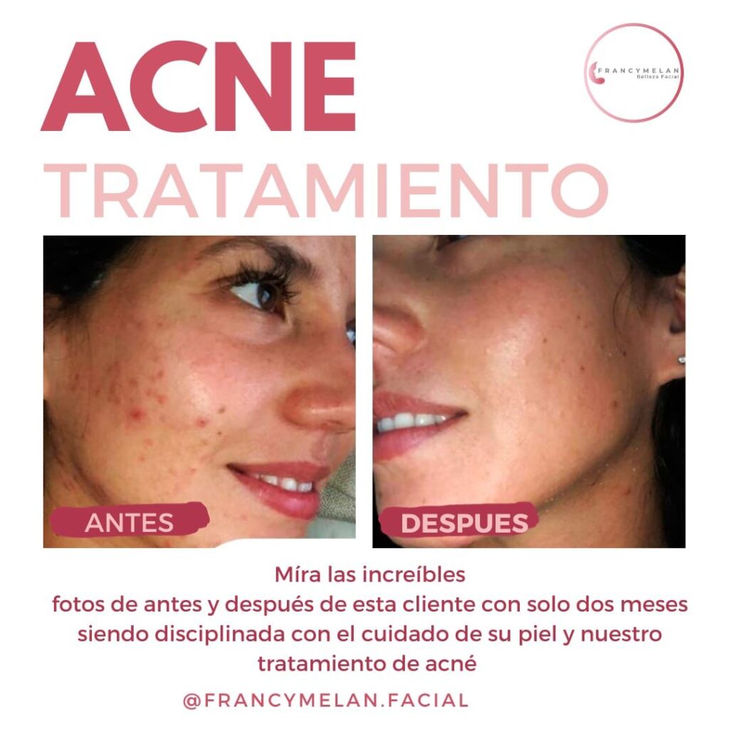 acne tratamiento