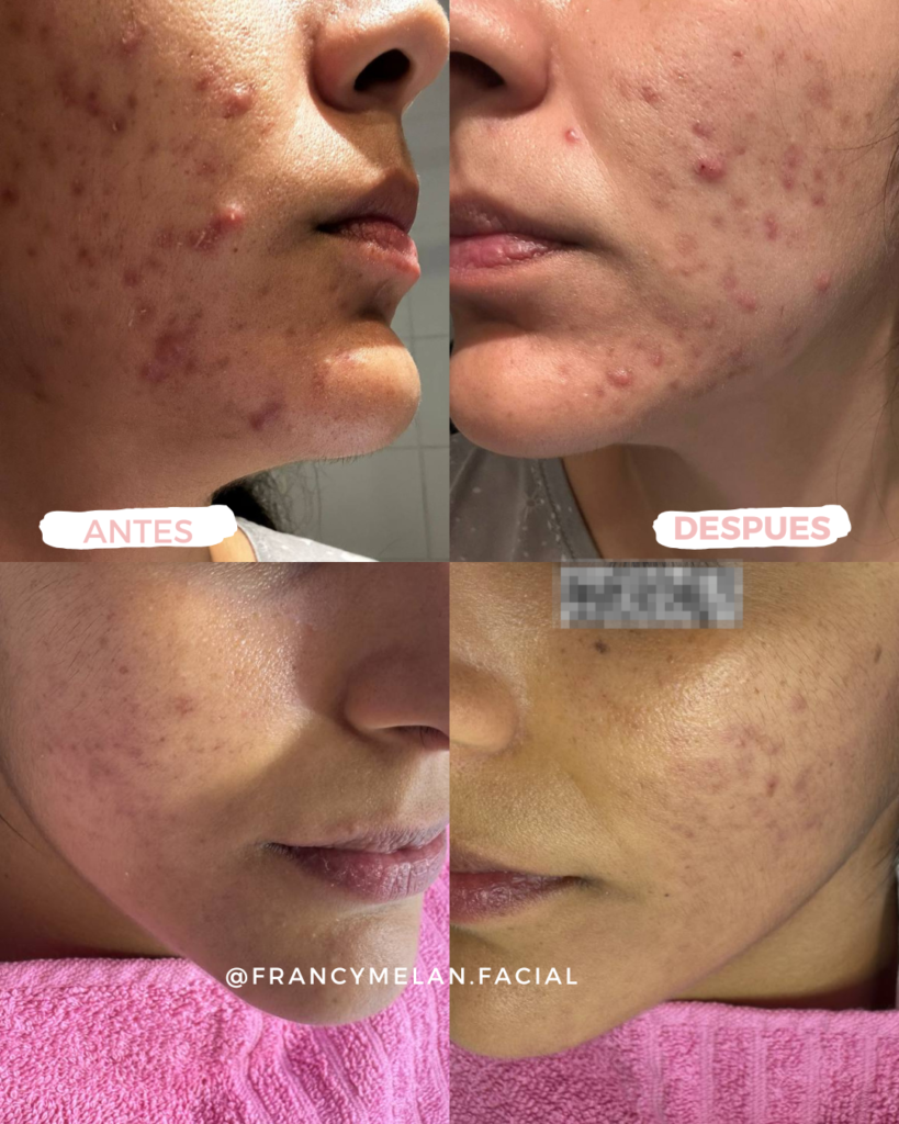 Antes y después de tratamiento acné