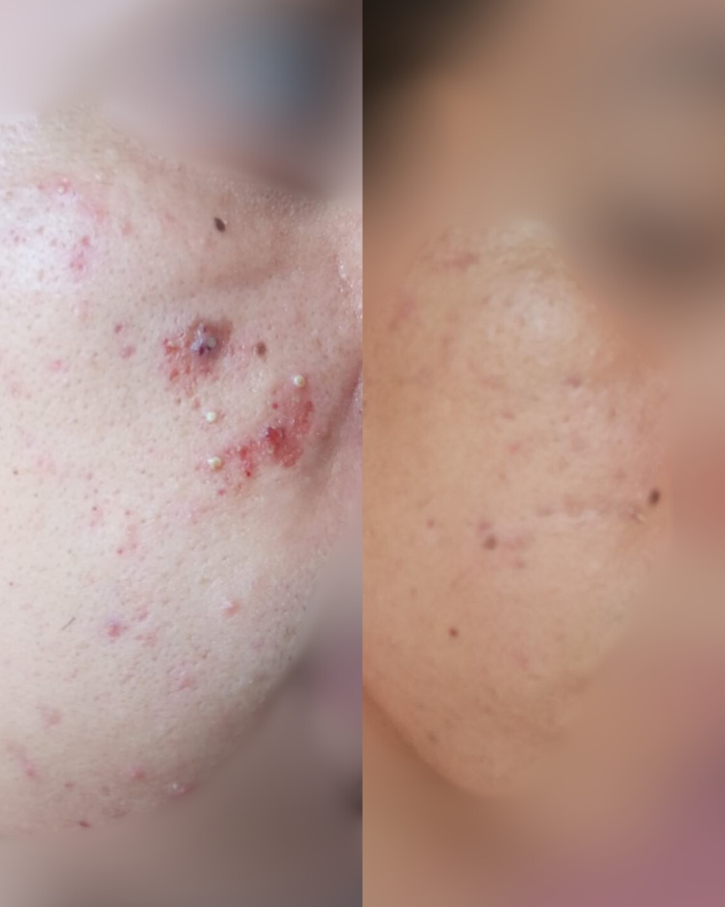 Antes y después del tratamiento Acné en Francy Melan