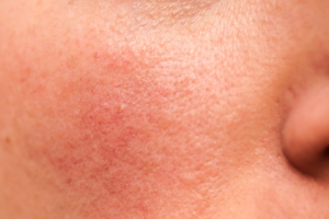 Tratamientos de Estética Facial para Piel Sensible en Santiago de Chile